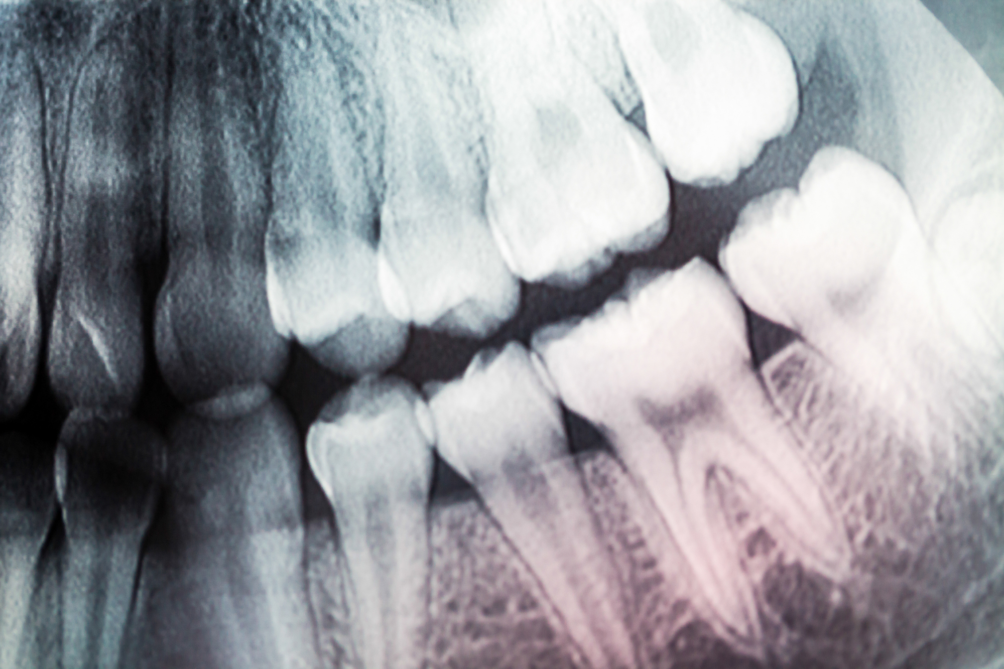 Может ли вырасти новый зуб. Анатомия зубов рентген.